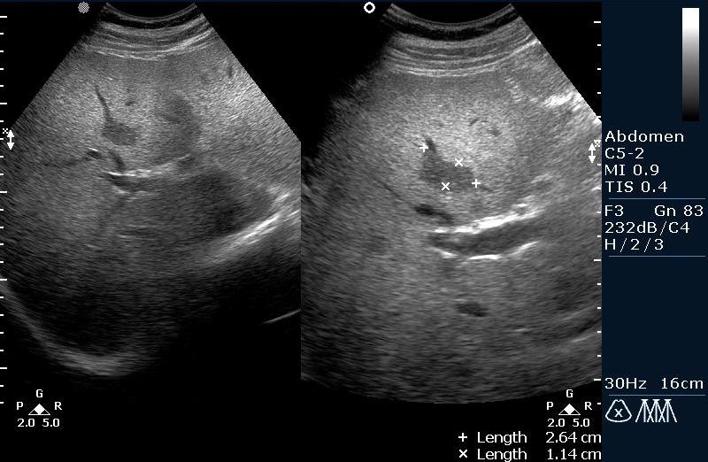 Как выглядит жировой гепатоз печени на узи фото